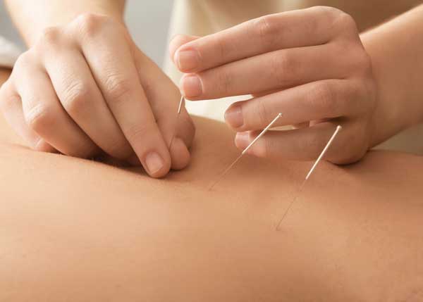 Functional Dry Needling Therapy | Peak Physical Therapy &amp; Wellness