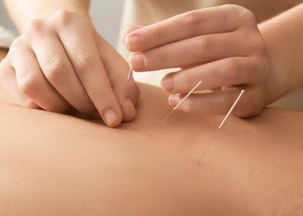 Dry Needling in Denver 