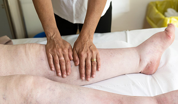 lymphedema treatment